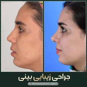 rhinoplasty-98