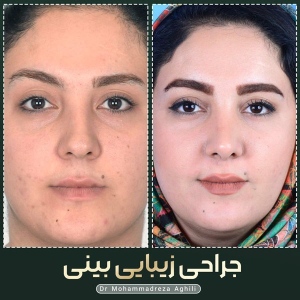 rhinoplasty-99