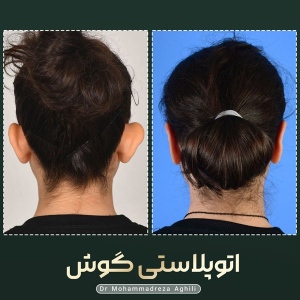 otoplasty-1