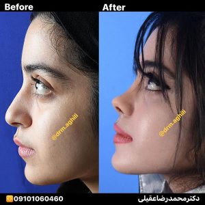 نمونه جراحی بینی دکتر محمدرضا عقیلی