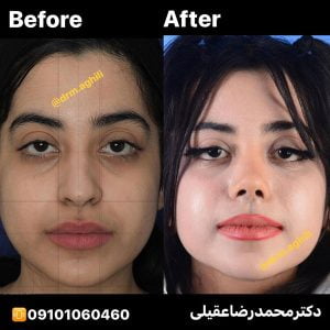 نمونه جراحی بینی دکتر محمدرضا عقیلی