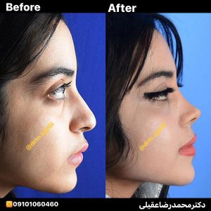 نمونه جراحی بینی دکتر محمدرضا عقیلی