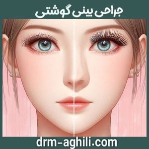 جراحی بینی گوشتی دکتر عقیلی بهترین جراح بینی در گرگان