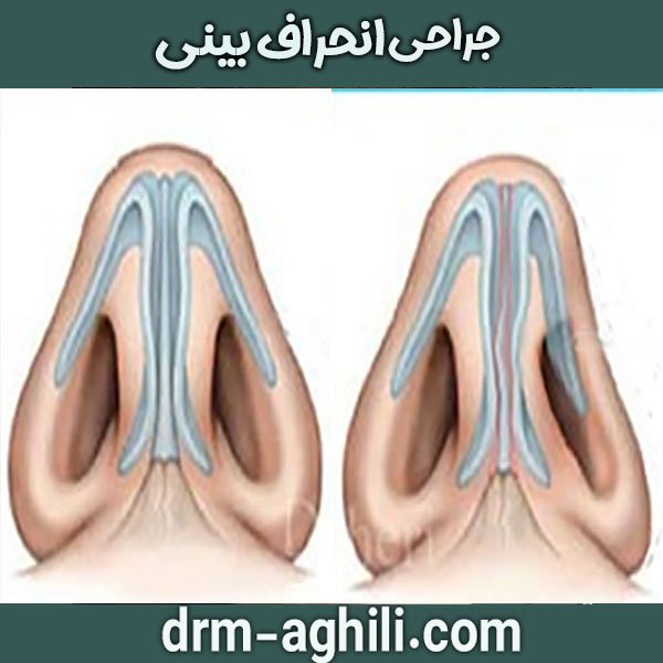 جراحی انحراف بینی