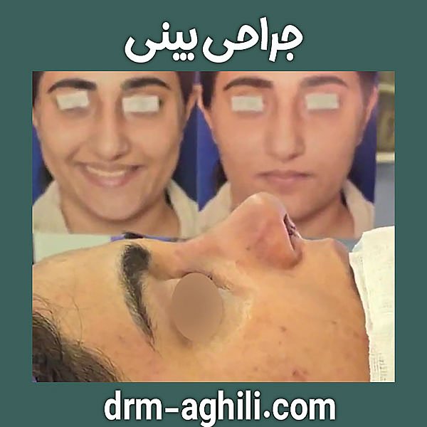 جراحی بینی