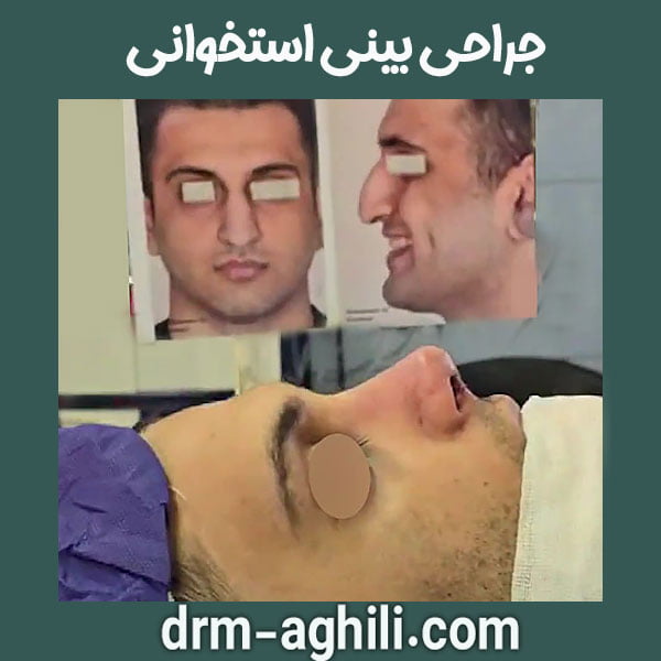 جراحی بینی استخوانی