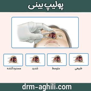 پولیپ بینی | دکتر محمدرضا عقیلی