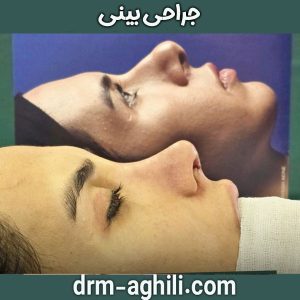 جراحی بینی دکتر محمدرضا عقیلی در گرگان