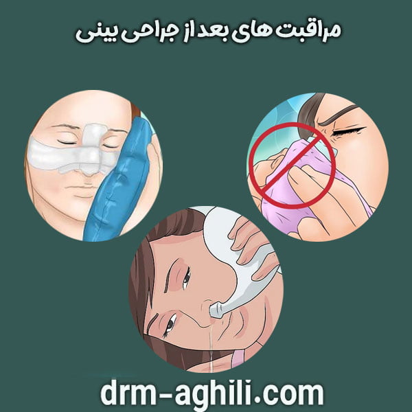 مراقبت های بعد از جراحی بینی دکتر عقیلی در گرگان