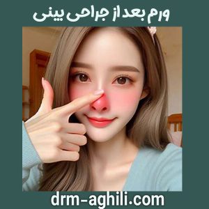 ورم بعد از جراحی بینی ، دکتر عقیلی در گرگان