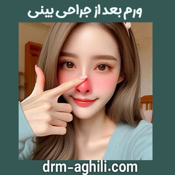 ورم بعد از جراحی بینی ، دکتر عقیلی در گرگان