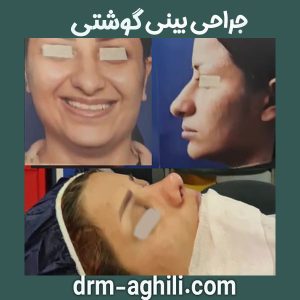جراحی بینی گوشتی از دکتر محمدرضا عقیلی در گرگان