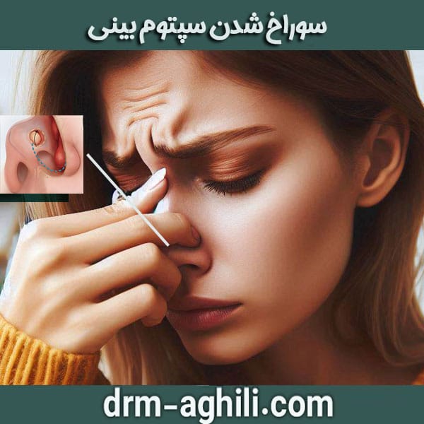 سوراخ شدن سپتوم بینی دکتر عقیلی بهترین جراح بینی در گرگان