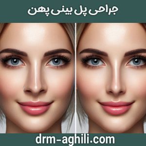جراحی پل بینی پهن دکتر محمدرضا عقیلی در گرگان 