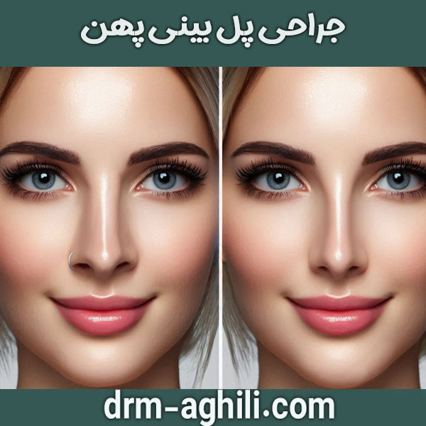 جراحی پل بینی پهن دکتر محمدرضا عقیلی در گرگان