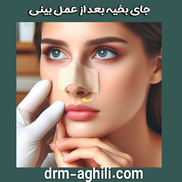 جای بخیه بعد از عمل بینی از دکتر محمدرضا عقیلی در گرگان