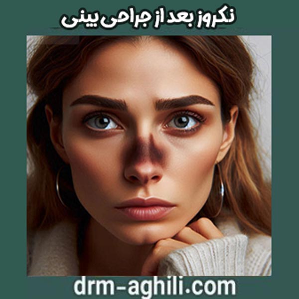نکروز بعد از جراحی بینی